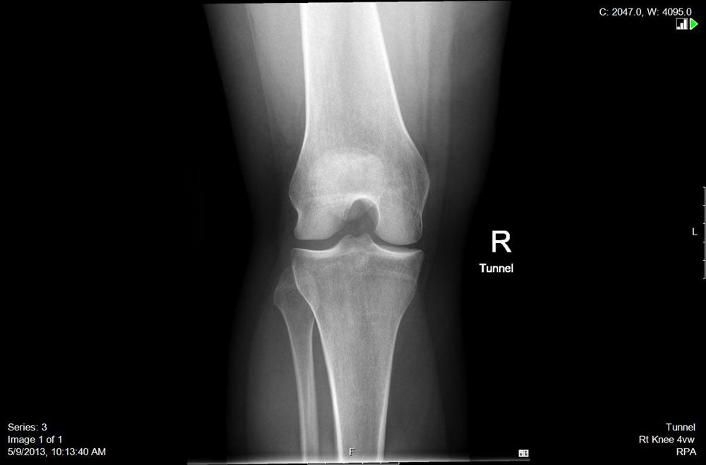 Idiopathic Chondromalacia Patellae Knee & Sports Orthobullets